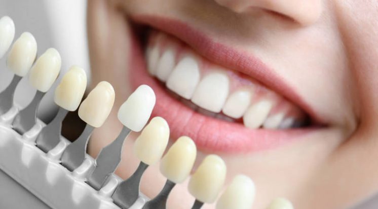 05 motivos para investir em Facetas de Porcelana.