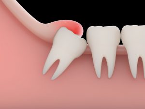 Em quais casos é preciso extrair um dente?
