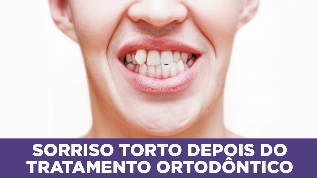 Dentes TORTOS depois de TRATAMENTO ORTODÔNTICO - Sorrix