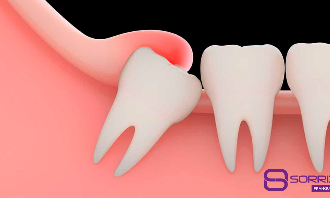 7 curiosidades sobre o dente siso